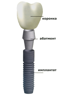 импланты мытищи
